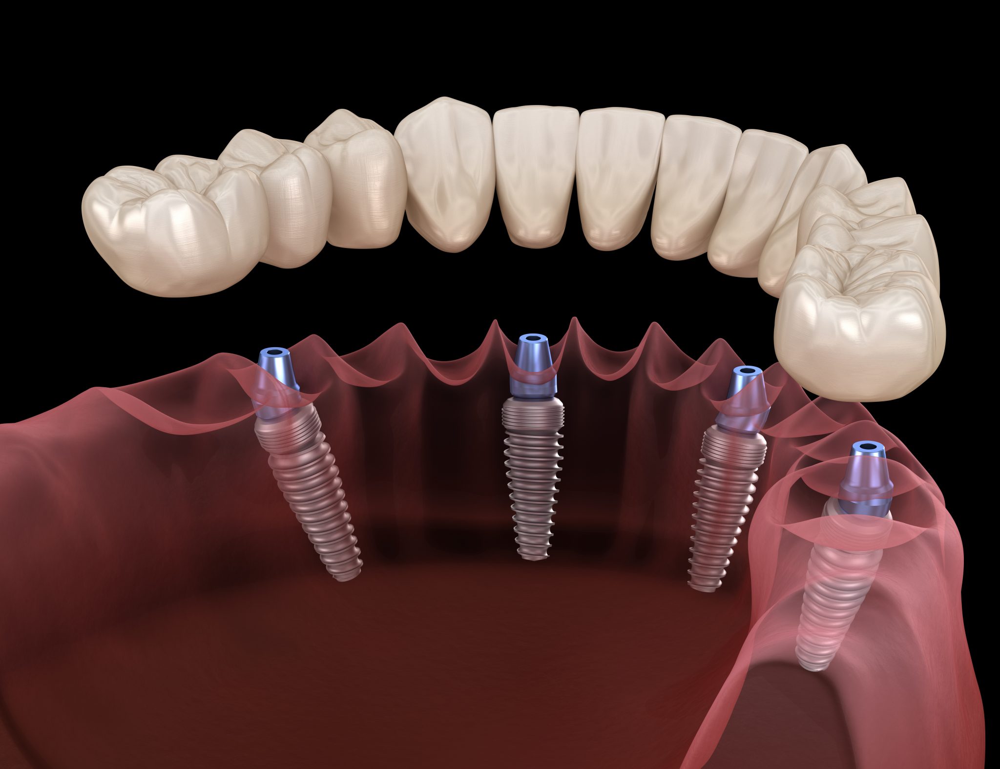 Зубные имплантаты – что это