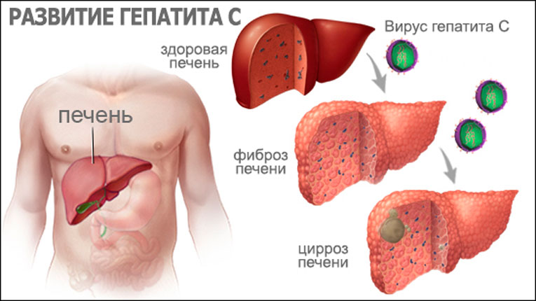 hepatitc